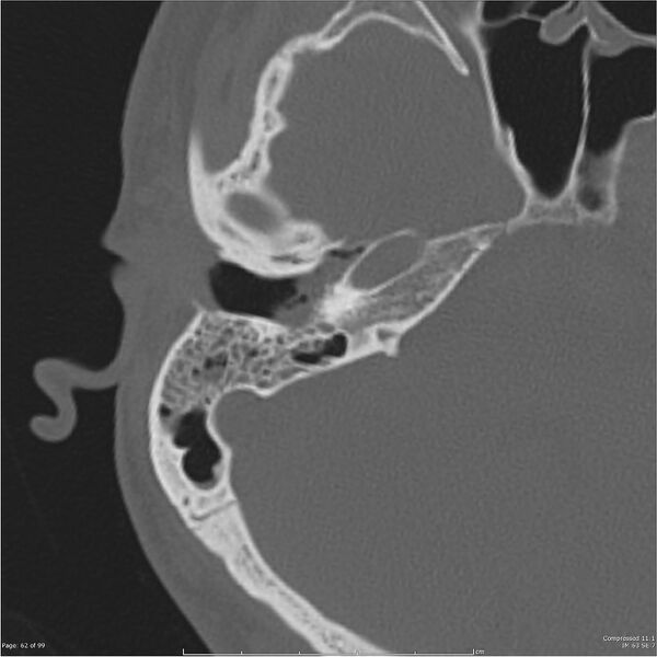 File:Acute otomastoiditis (Radiopaedia 28276-28512 Axial PTB bone window reformat 42).jpg
