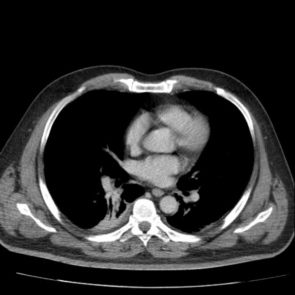 File:Acute pancreatitis (Radiopaedia 26663-26813 Axial C+ portal venous phase 1).jpg