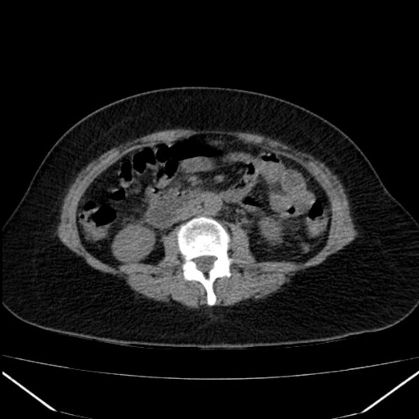 File:Acute pancreatitis - Balthazar C (Radiopaedia 26569-26714 Axial non-contrast 49).jpg