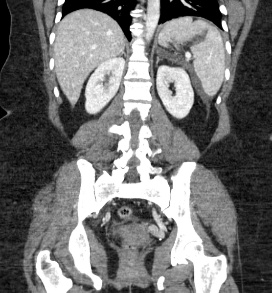 File:Acute pancreatitis - Balthazar E (Radiopaedia 29016-29377 Coronal C+ portal venous phase 64).png
