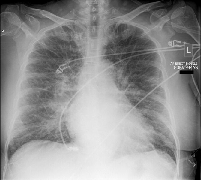 File:Acute pulmonary edema (Radiopaedia 63317).jpg
