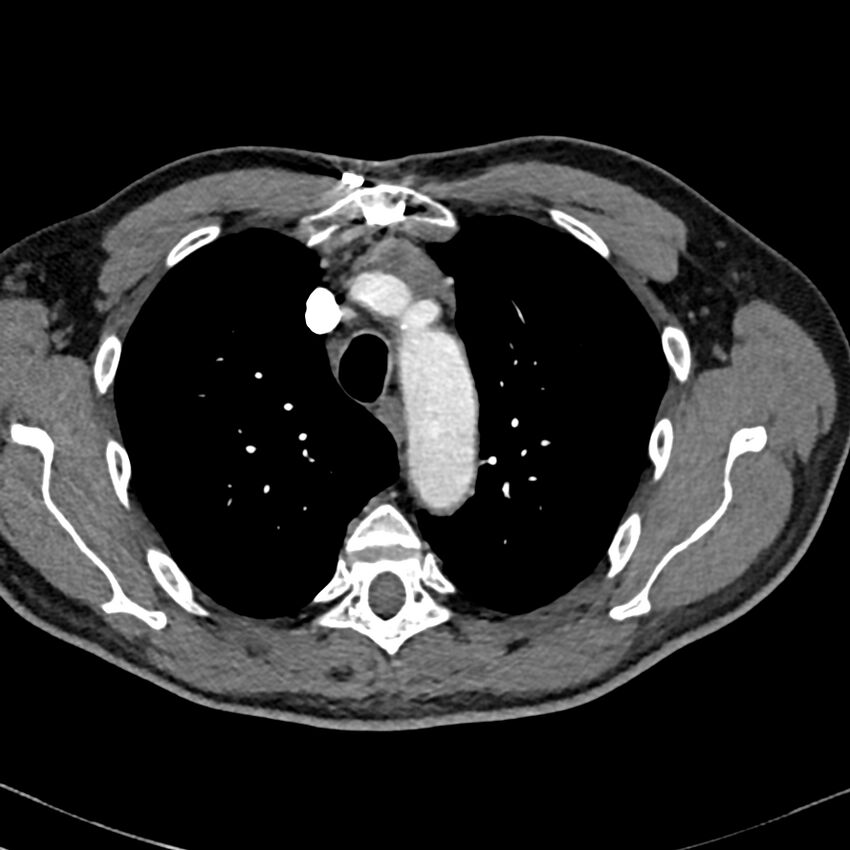 Acute pulmonary embolism (Radiopaedia 81677-95570 Axial C+ CTPA 6).jpg