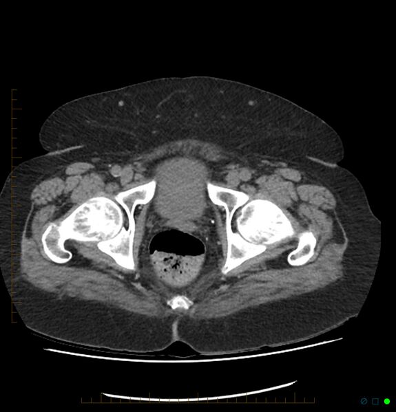 File:Acute renal failure post IV contrast injection- CT findings (Radiopaedia 47815-52557 Axial non-contrast 78).jpg