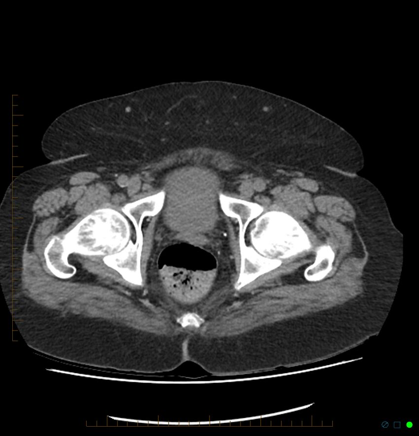 Acute renal failure post IV contrast injection- CT findings (Radiopaedia 47815-52557 Axial non-contrast 78).jpg