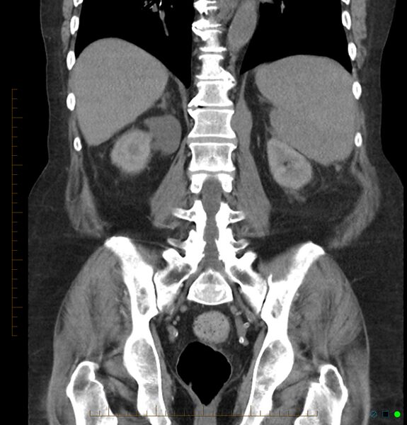 File:Acute renal failure post IV contrast injection- CT findings (Radiopaedia 47815-52557 Coronal non-contrast 34).jpg