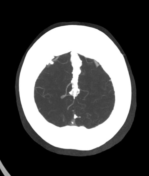 File:Acute right MCA M1 occlusion (Radiopaedia 62268-70454 Axial Phase 1 5).jpg