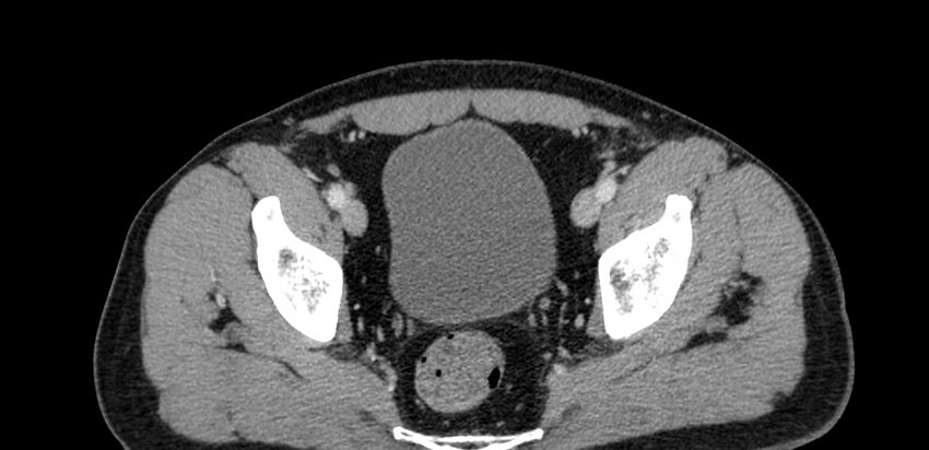 Acute sigmoid colon diverticulitis (Radiopaedia 55507-61976 Axial C+ portal venous phase 104).jpg