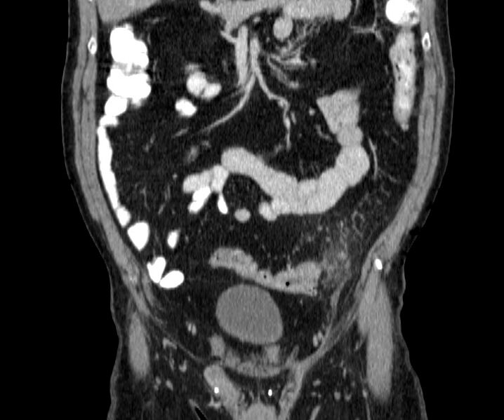 File:Acute sigmoid colon diverticulitis (Radiopaedia 55507-61976 Coronal C+ portal venous phase 46).jpg