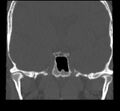 Acute sinusitis (Radiopaedia 23161-23215 Coronal bone window 56).jpg