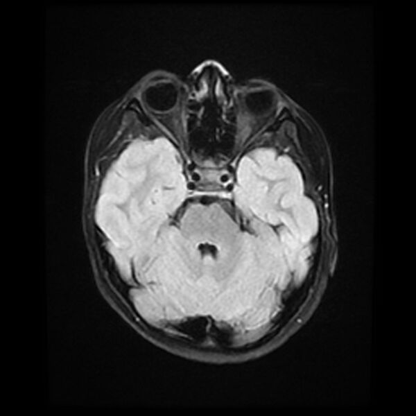 File:Adamantinomatous craniopharyngioma (Radiopaedia 77407-89529 Axial FLAIR 8).jpg