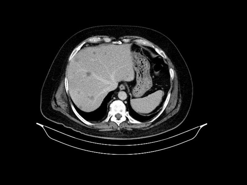File:Adenocarcinoma of pancreas with hepatic metastasis (Radiopaedia 64332-73122 Axial C+ delayed 19).jpg