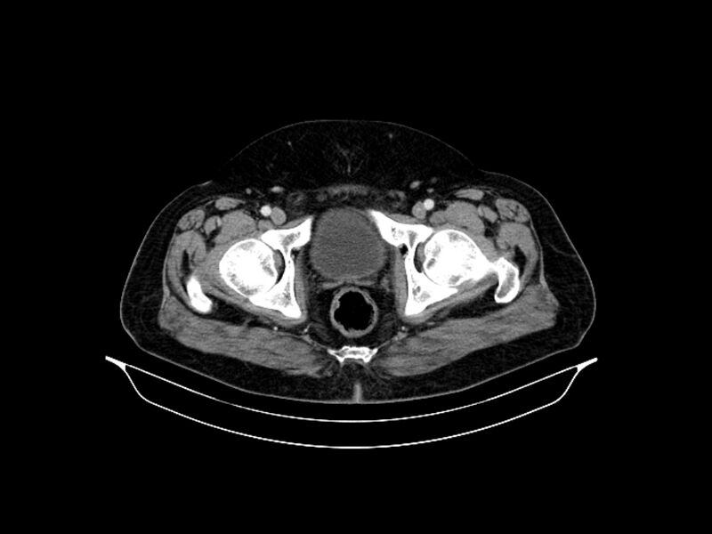 File:Adenocarcinoma of pancreas with hepatic metastasis (Radiopaedia 64332-73122 Axial C+ portal venous phase 97).jpg