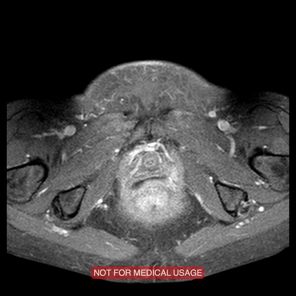 File:Adenocarcinoma of the cervix (Radiopaedia 28373-28615 Axial T1 C+ fat sat 2).jpg