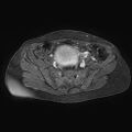 Adenomyoma of the uterus (huge) (Radiopaedia 9870-10438 Axial T1 C+ fat sat 23).jpg