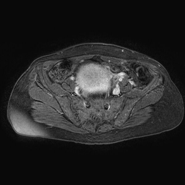 File:Adenomyoma of the uterus (huge) (Radiopaedia 9870-10438 Axial T1 C+ fat sat 23).jpg