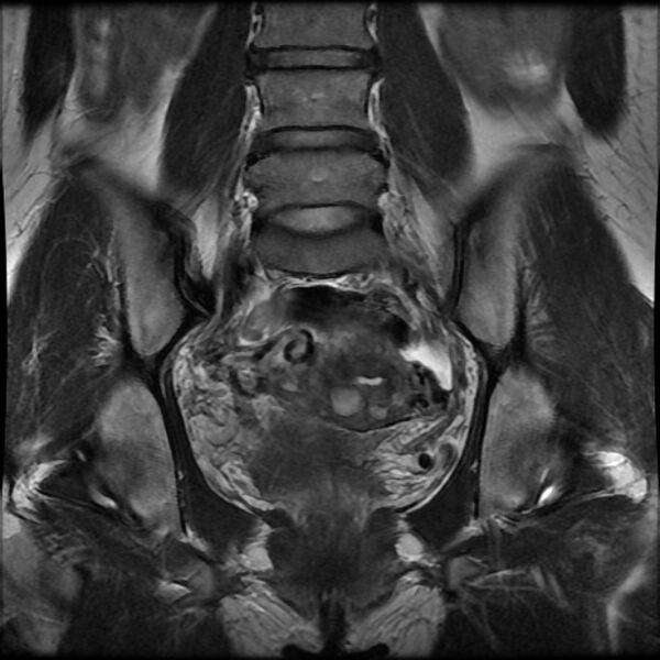 File:Adenomyosis on MRI (Radiopaedia 29328-29780 Coronal T2 6).jpg