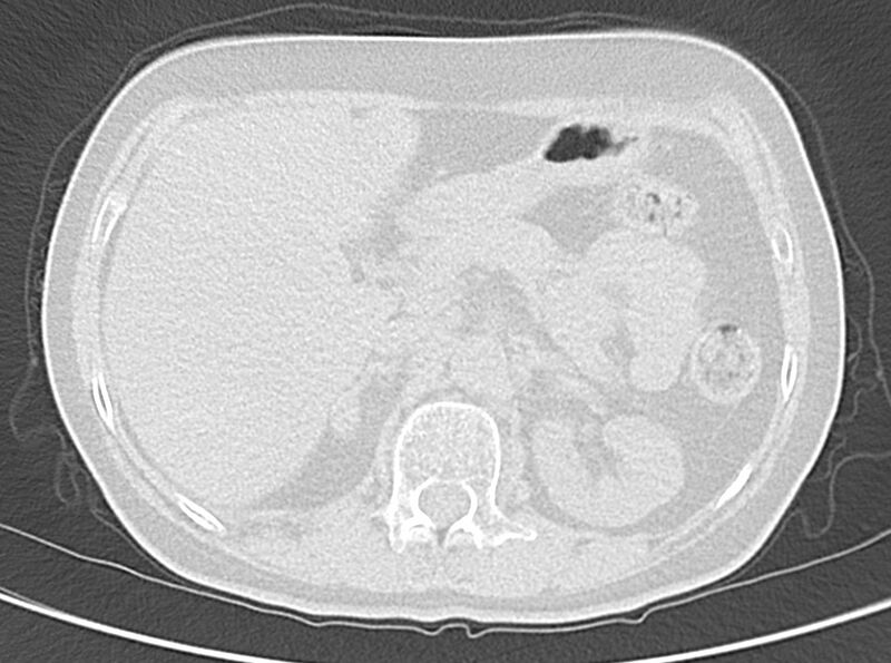 File:Adenosquamous lung carcinoma (Radiopaedia 22035-22030 lung window 63).jpg