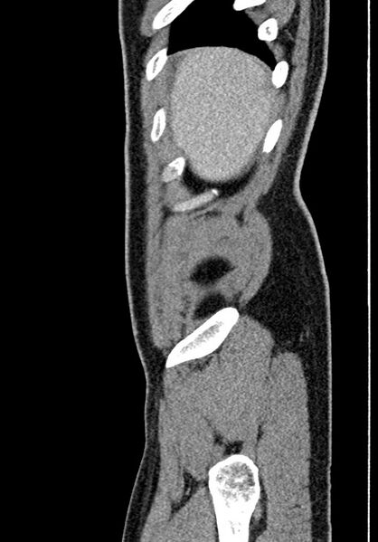 File:Adhesional small bowel obstruction (Radiopaedia 58900-66131 Sagittal C+ portal venous phase 24).jpg