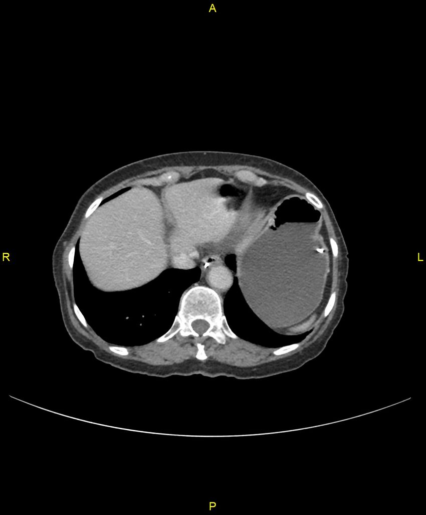 Adhesional small bowel obstruction (Radiopaedia 85402-101024 Axial C+ portal venous phase 38).jpg
