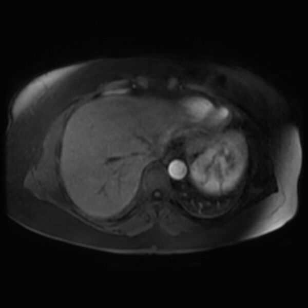 File:Adrenal cortical carcinoma (Radiopaedia 70906-81116 Axial Postcontrast-Dyn T1 fat sat 5).jpg