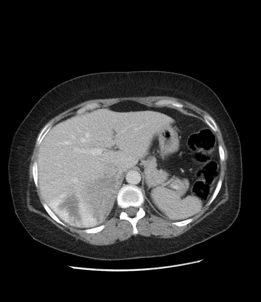 Adrenal cortical carcinoma with IVC invasion and thrombosis (Radiopaedia 34307-35597 Axial C+ portal venous phase 20).jpg