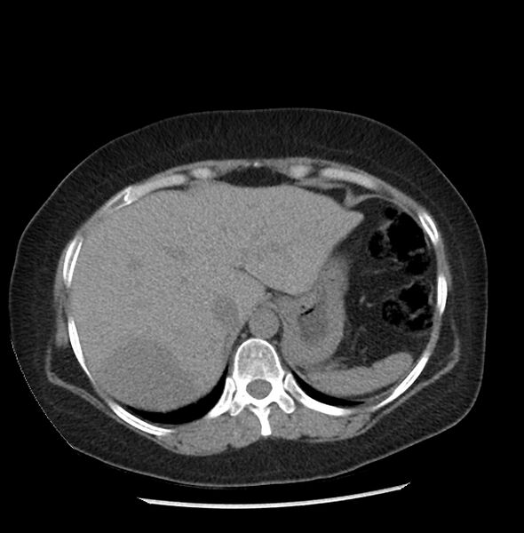 File:Adrenal cortical carcinoma with IVC invasion and thrombosis (Radiopaedia 34307-35597 Axial non-contrast 5).jpg