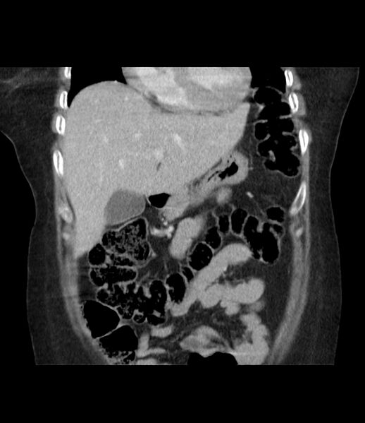 File:Adrenal cortical carcinoma with IVC invasion and thrombosis (Radiopaedia 34307-35597 Coronal C+ portal venous phase 18).jpg