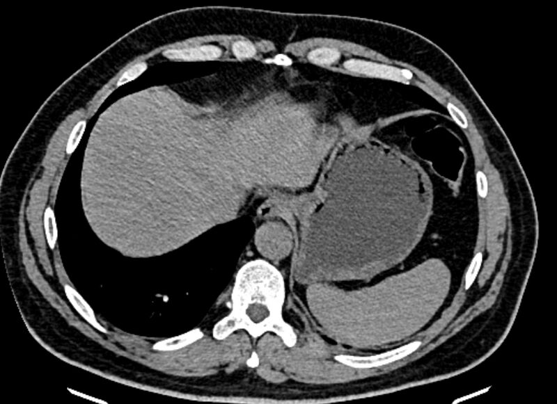 File:Adrenal metastases (Radiopaedia 73082-83791 Axial non-contrast 22).jpg