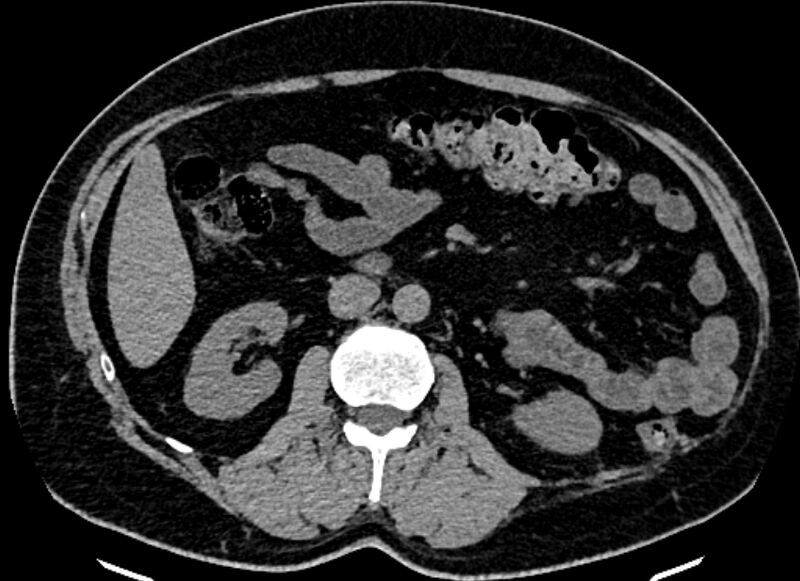 File:Adrenal metastases (Radiopaedia 73082-83791 Axial non-contrast 87).jpg