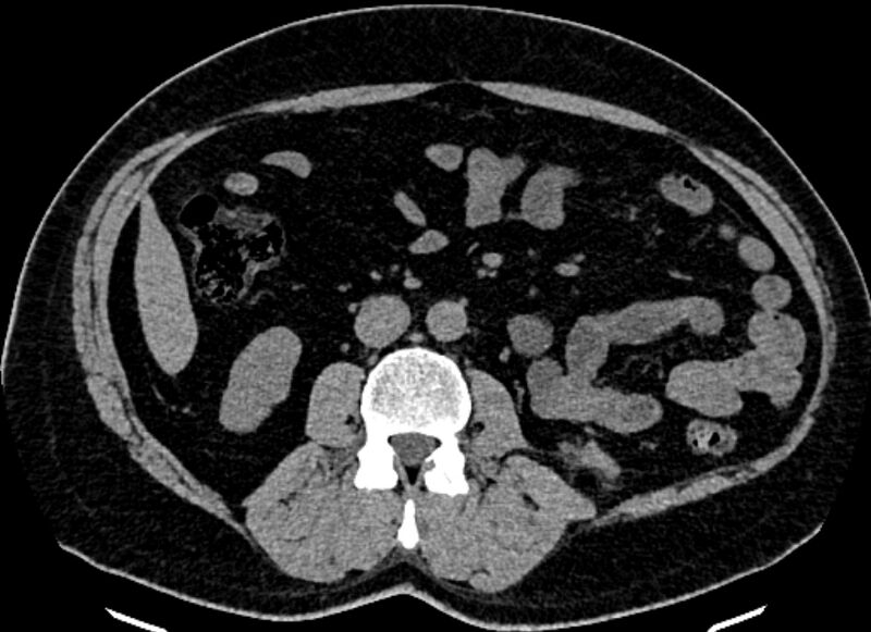 File:Adrenal metastases (Radiopaedia 73082-83791 Axial non-contrast 96).jpg