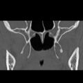 Ameloblastic fibro-odontoma (Radiopaedia 18843-18780 B 22).jpg