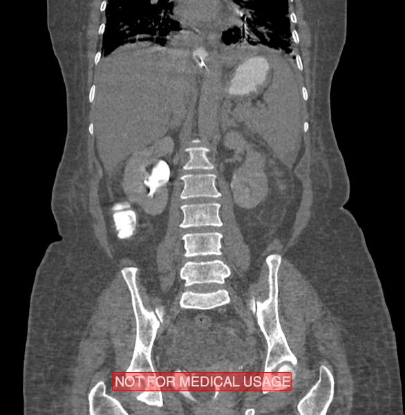 File:Amoebic enterocolitis with liver abscess (Radiopaedia 35100-36609 B 127).jpg