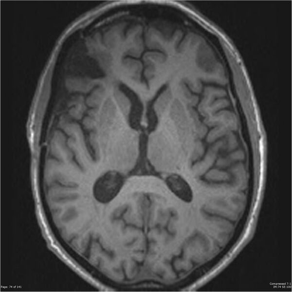 File:Anaplastic meningioma with recurrence (Radiopaedia 34452-35788 Axial T1 72).jpg