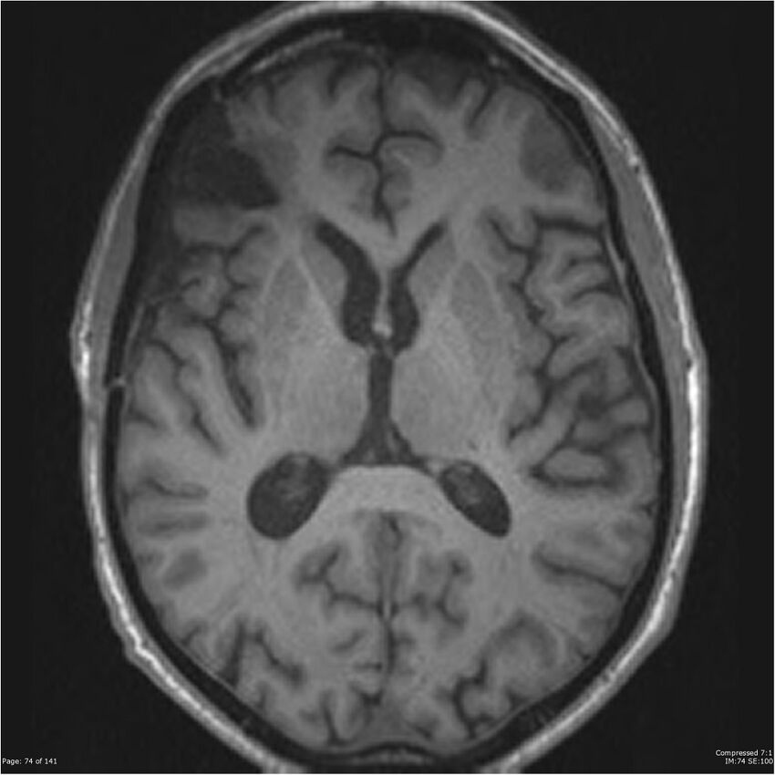 Anaplastic meningioma with recurrence (Radiopaedia 34452-35788 Axial T1 72).jpg