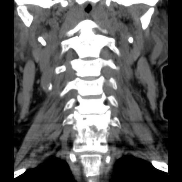 File:Anterior cervical postdiscectomy arthrodesis (Radiopaedia 32678-33646 Coronal non-contrast 10).jpg
