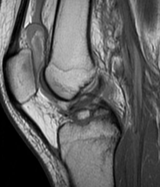 File:Anterior cruciate ligament bony avulsion (MRI) (Radiopaedia 14273-14151 Sagittal T1 1).jpg