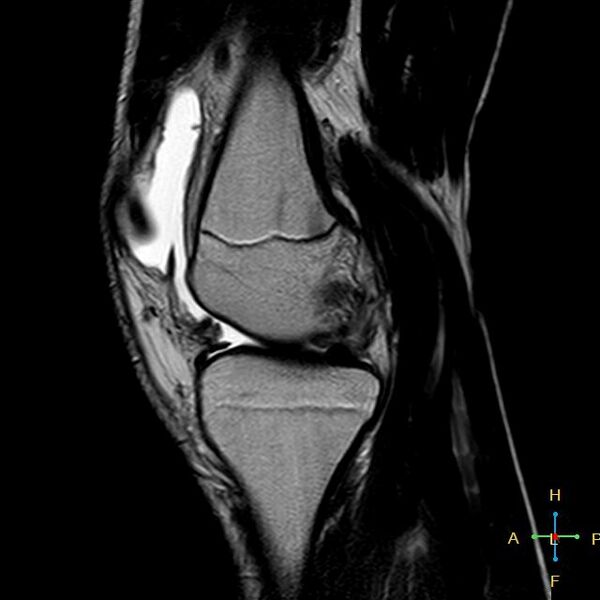 File:Anterior cruciate ligament tear - complete (Radiopaedia 24907-25170 Sagittal T2 12).jpg