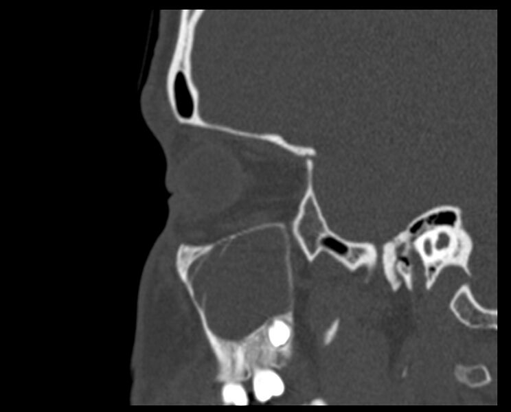 File:Antrochoanal polyp (Radiopaedia 21894-21868 Sagittal bone window 8).jpg
