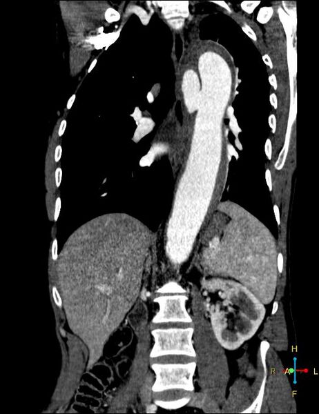 File:Aortic aneurysm and penetrating ulcer (Radiopaedia 23590-23704 B 12).jpg