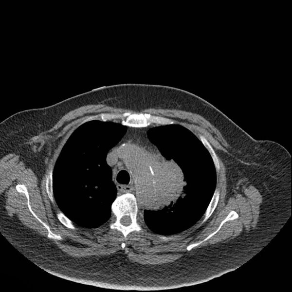 File:Aortic arch false aneurysm (Radiopaedia 14667-14587 Axial non-contrast 9).jpg