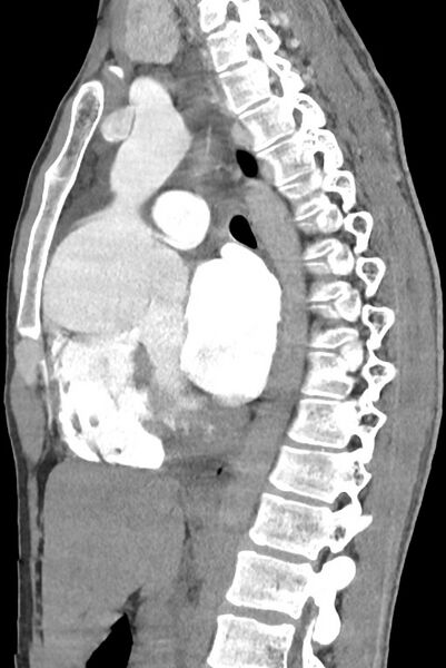 File:Aortic coarctation with aneurysm (Radiopaedia 74818-85828 B 88).jpg