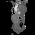 Aortic dissection (Radiopaedia 68763-78691 B 6).jpeg
