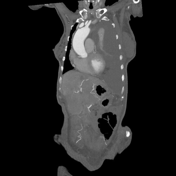 File:Aortic dissection (Radiopaedia 68763-78691 B 6).jpeg