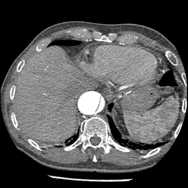 File:Aortic dissection - DeBakey Type I-Stanford A (Radiopaedia 79863-93115 A 33).jpg