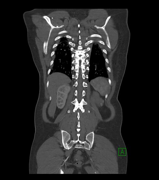 File:Aortic dissection with renal ischemia (Radiopaedia 76573-88338 C 33).jpg