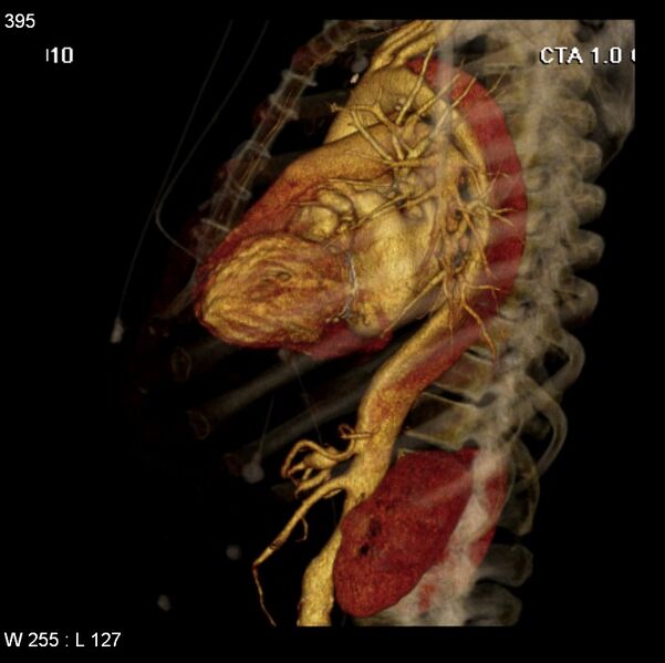 File:Aortic dissection with rupture into pericardium (Radiopaedia 12384-12647 C+ arterial phase 27).jpg