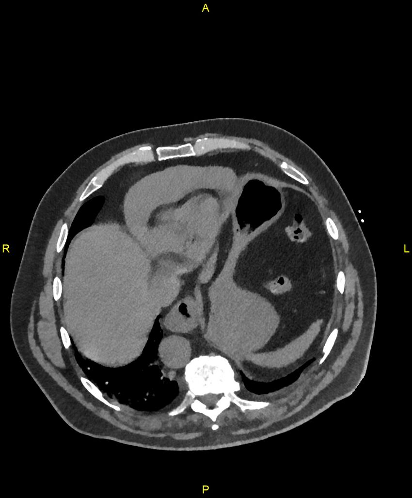Aortic rupture (Radiopaedia 88822-105594 Axial non-contrast 190).jpg