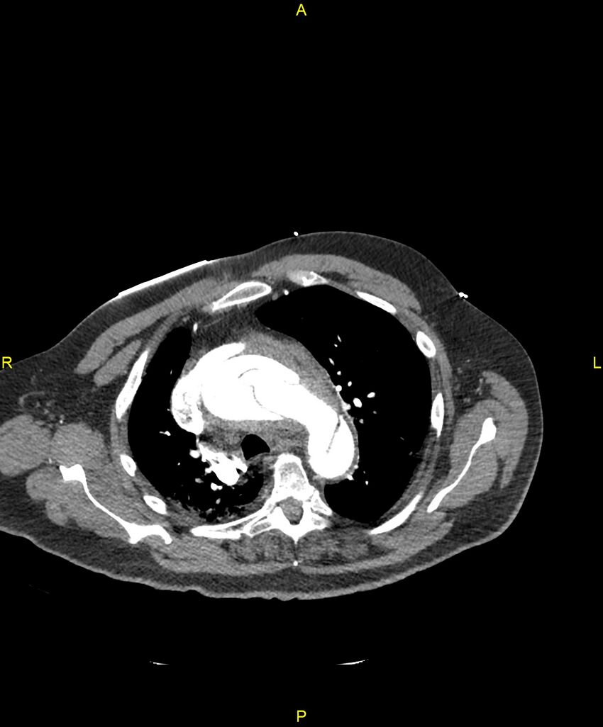 Aortic rupture (Radiopaedia 88822-105594 B 74).jpg