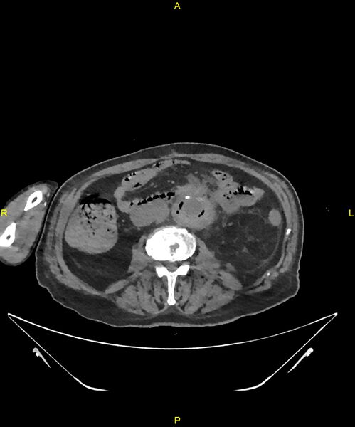 File:Aortoenteric fistula (Radiopaedia 84308-99603 Axial non-contrast 187).jpg