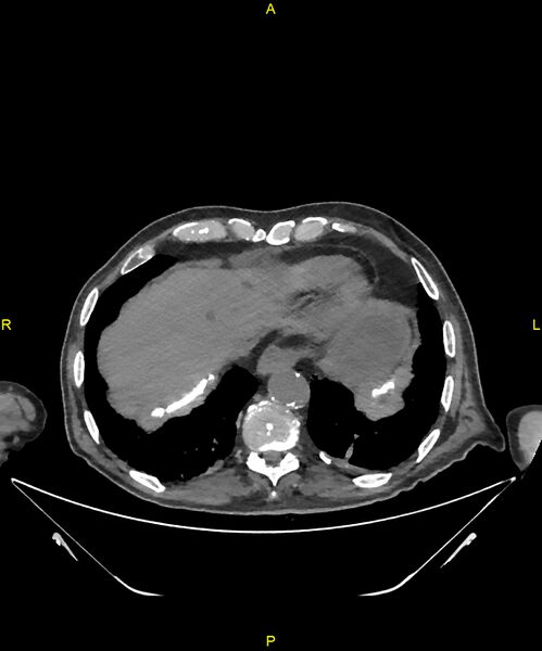 File:Aortoenteric fistula (Radiopaedia 84308-99603 Axial non-contrast 19).jpg